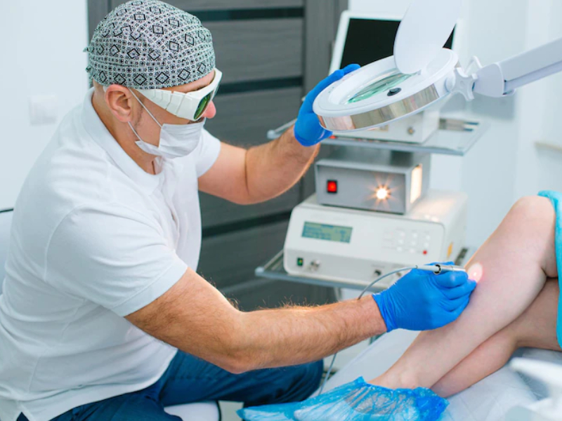 laser spider vein removal
