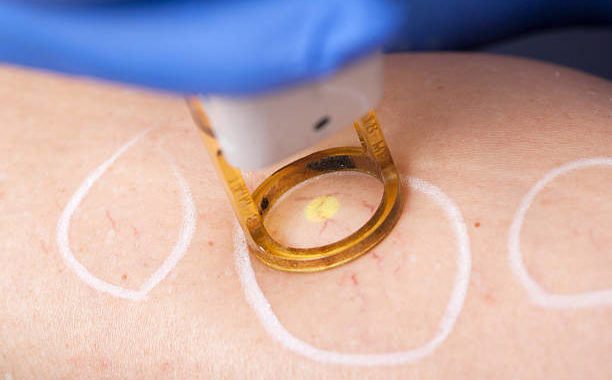 laser spider vein removal