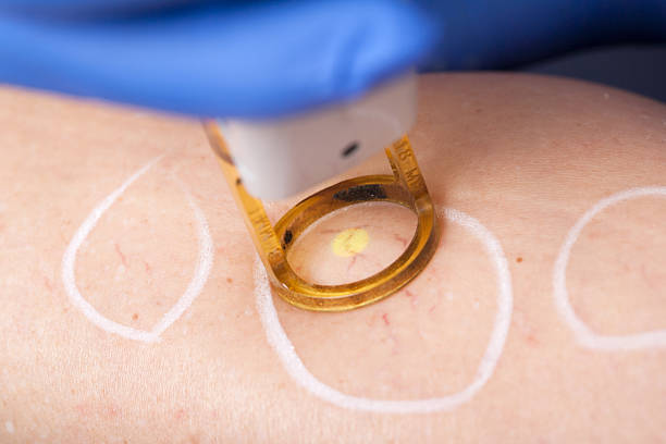 laser spider vein removal