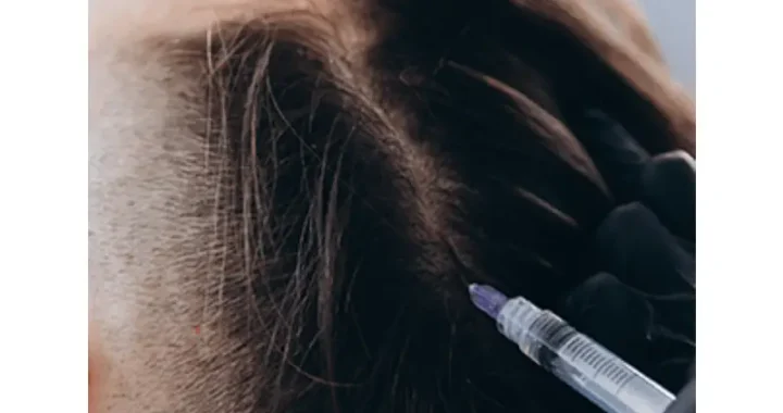 Mesotherapy in Istanbul