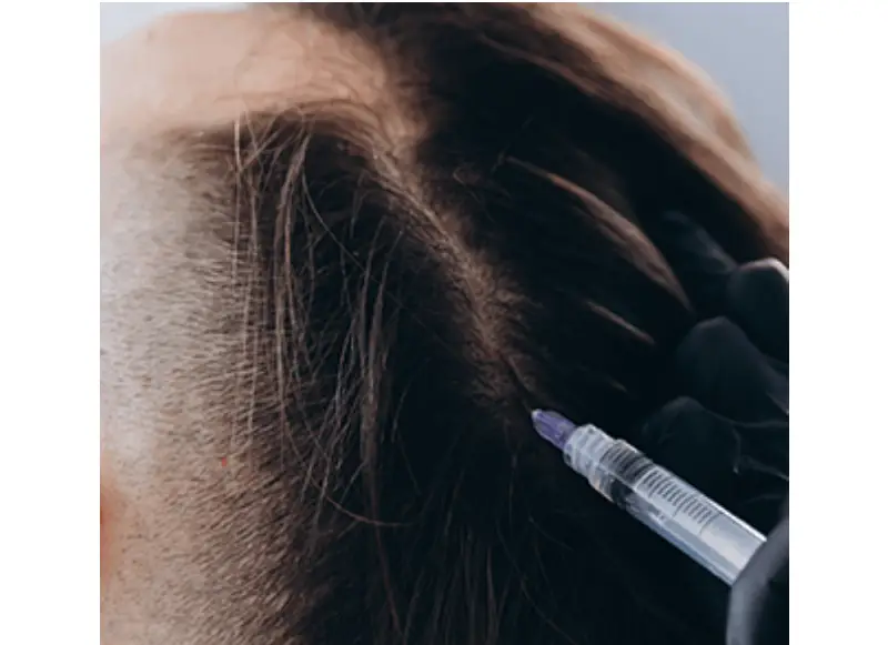 Mesotherapy in Istanbul