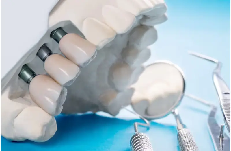 All-On-X Dental Implants In Pembroke Pines